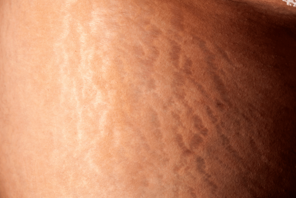 bain froid et cellulite