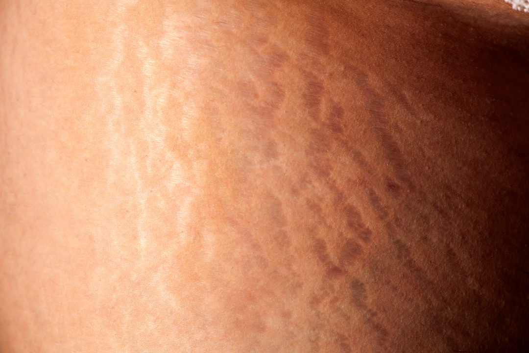 bain froid et cellulite