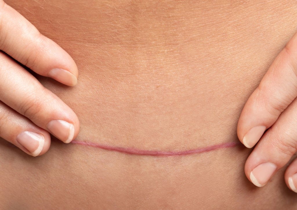 cicatrice gua sha du corps